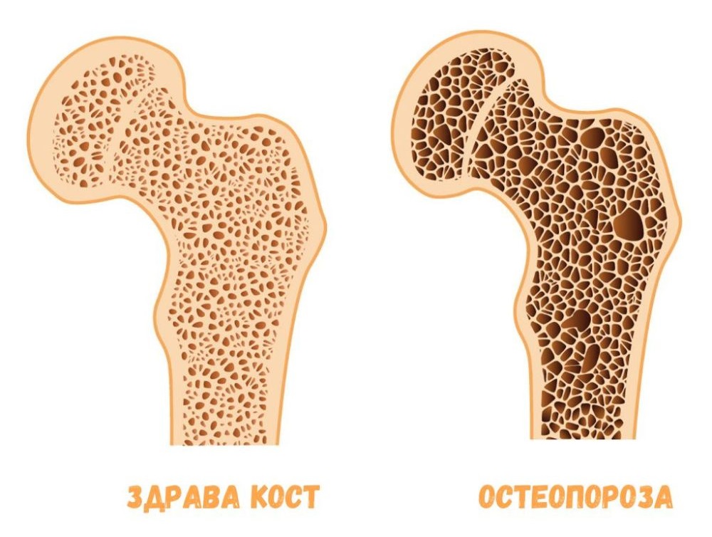 Здрава костна тъкан и изтънена костна тъкан при остеопороза