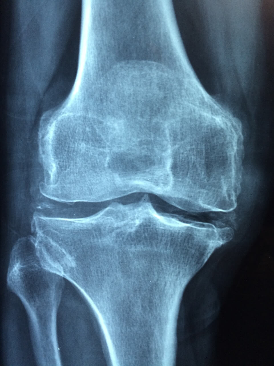 Рентгенова снимка преди операция на коляното.