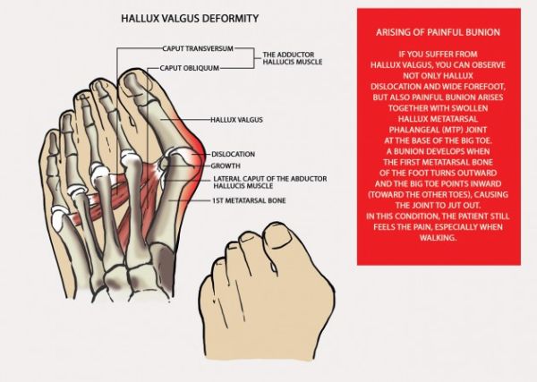 Bunion splint AM-OP-03