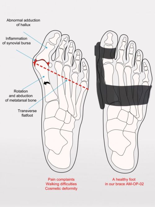 The bunion splint AM-OP-02